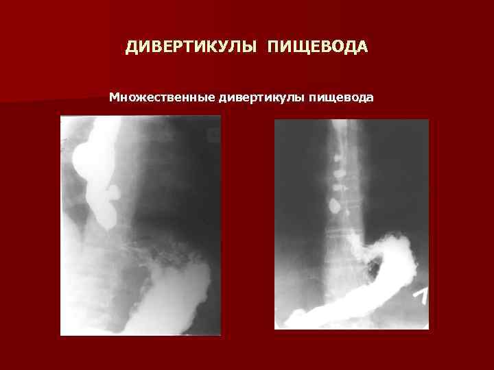 ДИВЕРТИКУЛЫ ПИЩЕВОДА Множественные дивертикулы пищевода 