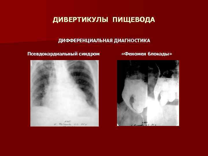 ДИВЕРТИКУЛЫ ПИЩЕВОДА ДИФФЕРЕНЦИАЛЬНАЯ ДИАГНОСТИКА Псевдокардиальный синдром «Феномен блокады» 