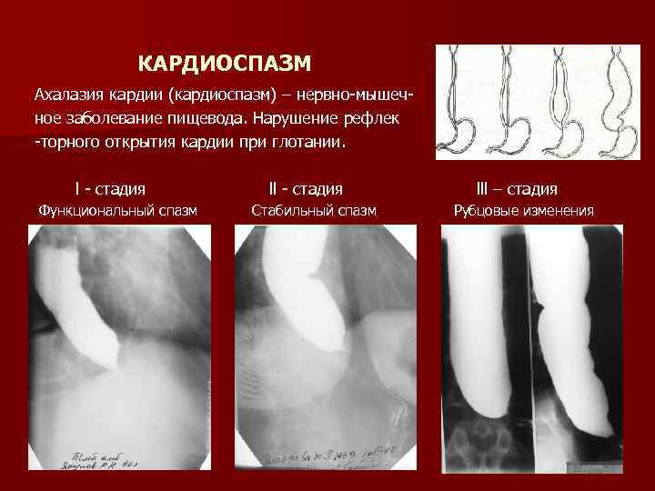 КАРДИОСПАЗМ Ахалазия кардии (кардиоспазм) – нервно мышеч ное заболевание пищевода. Нарушение рефлек торного открытия