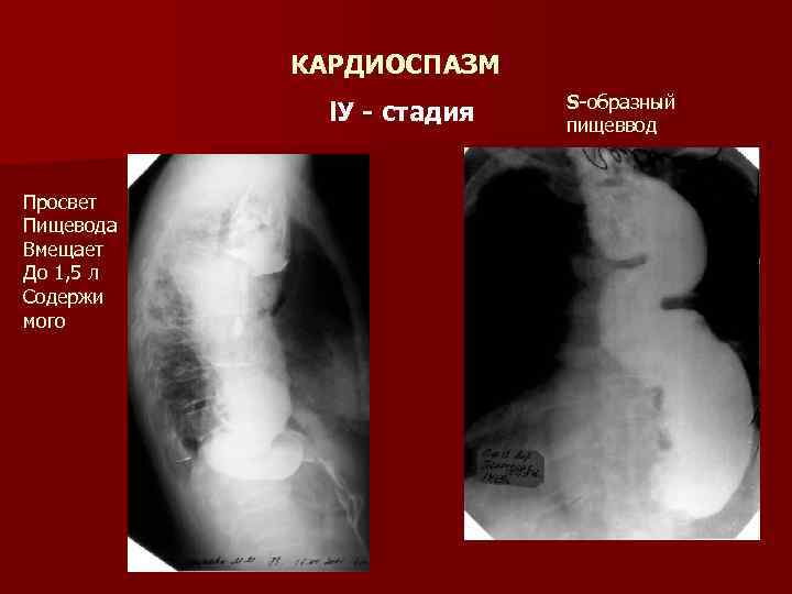 КАРДИОСПАЗМ l. У - стадия Просвет Пищевода Вмещает До 1, 5 л Содержи мого