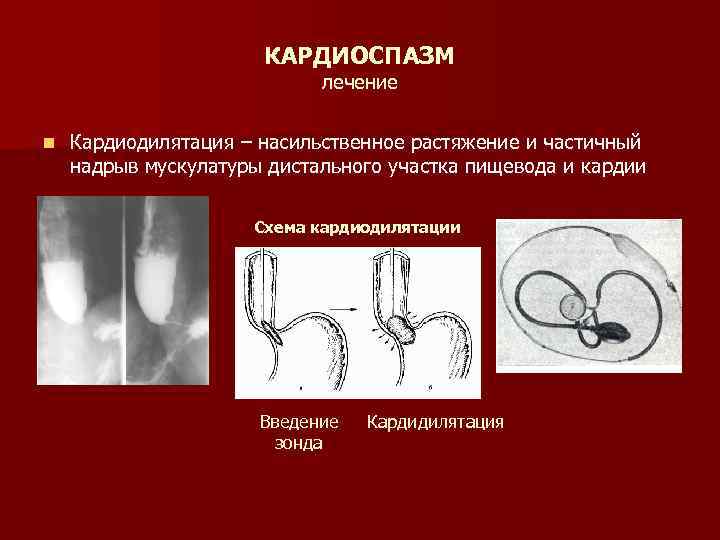 КАРДИОСПАЗМ лечение n Кардиодилятация – насильственное растяжение и частичный надрыв мускулатуры дистального участка пищевода