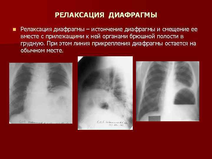 РЕЛАКСАЦИЯ ДИАФРАГМЫ n Релаксация диафрагмы – истончение диафрагмы и смещение ее вместе с прилежащими