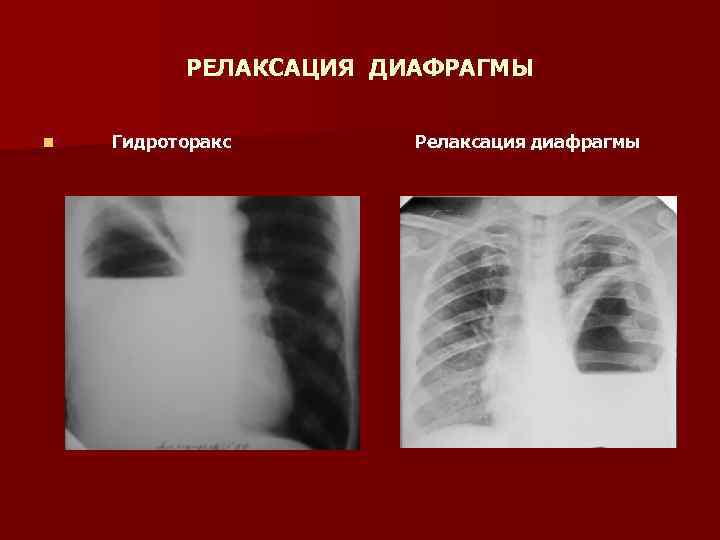 РЕЛАКСАЦИЯ ДИАФРАГМЫ n Гидроторакс Релаксация диафрагмы 