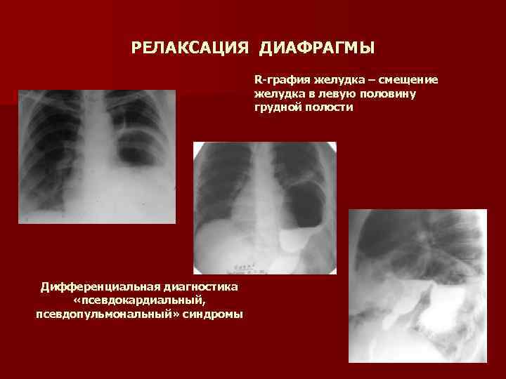 Заболевания диафрагмы презентация