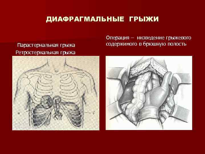 ДИАФРАГМАЛЬНЫЕ ГРЫЖИ Парастернальная грыжа Ретростернальная грыжа Операция – низведение грыжевого содержимого в брюшную полость