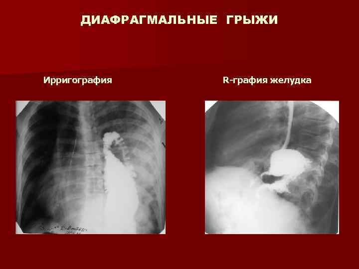 Заболевания диафрагмы презентация