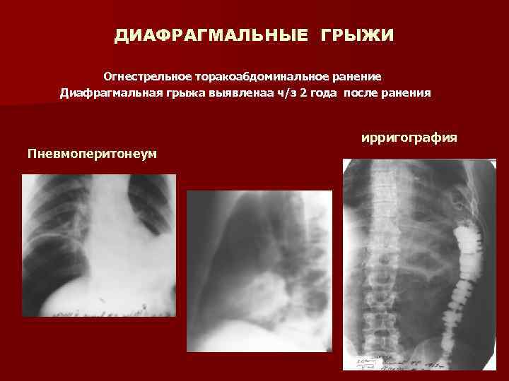 ДИАФРАГМАЛЬНЫЕ ГРЫЖИ Огнестрельное торакоабдоминальное ранение Диафрагмальная грыжа выявленаа ч/з 2 года после ранения ирригография