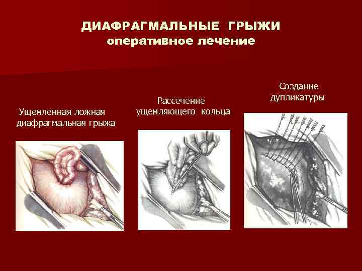 ДИАФРАГМАЛЬНЫЕ ГРЫЖИ оперативное лечение Ущемленная ложная диафрагмальная грыжа Рассечение ущемляющего кольца Создание дупликатуры 