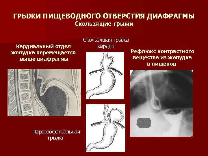 Грыжа пищеводного отверстия диафрагмы симптомы фото