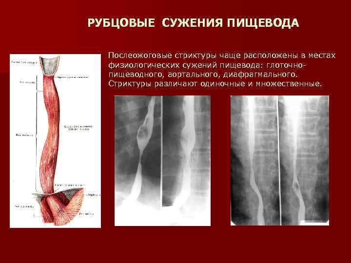 РУБЦОВЫЕ СУЖЕНИЯ ПИЩЕВОДА Послеожоговые стриктуры чаще расположены в местах физиологических сужений пищевода: глоточнопищеводного, аортального,