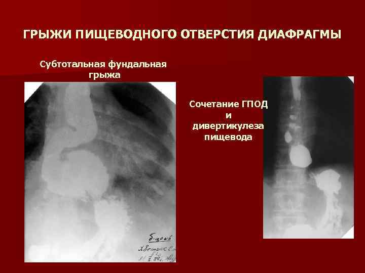 ГРЫЖИ ПИЩЕВОДНОГО ОТВЕРСТИЯ ДИАФРАГМЫ Субтотальная фундальная грыжа Сочетание ГПОД и дивертикулеза пищевода 