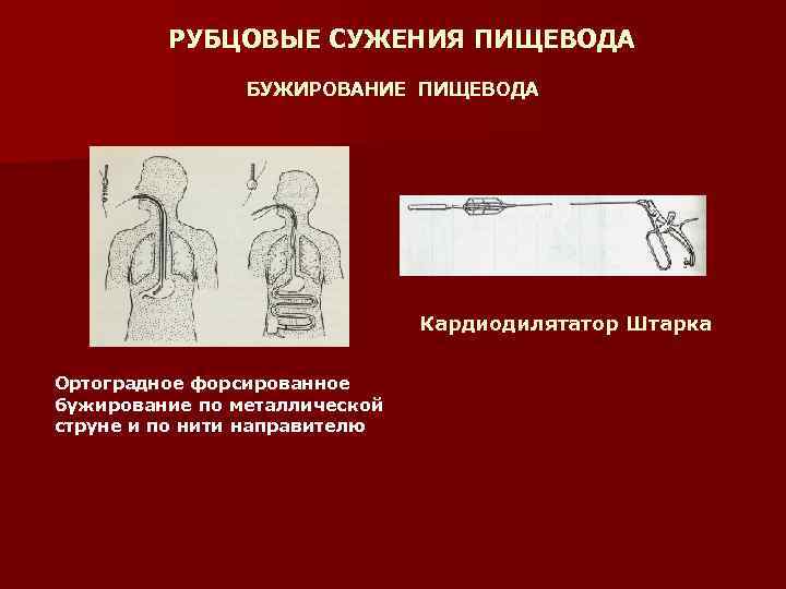 Бужирование пищевода