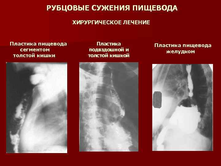 РУБЦОВЫЕ СУЖЕНИЯ ПИЩЕВОДА ХИРУРГИЧЕСКОЕ ЛЕЧЕНИЕ Пластика пищевода сегментом толстой кишки Пластика подвздошной и толстой