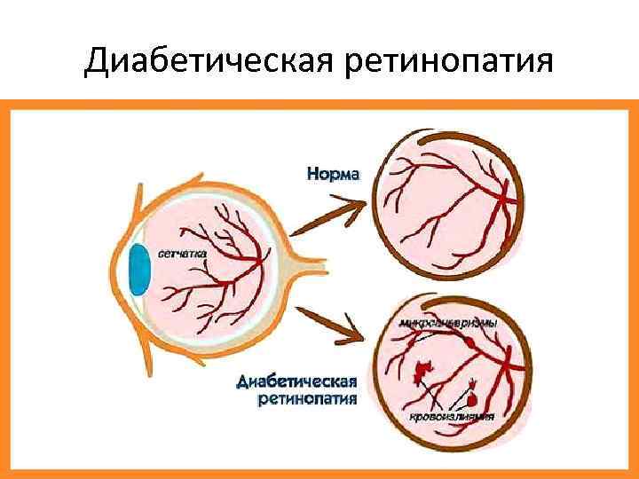 Диабетическая ретинопатия 