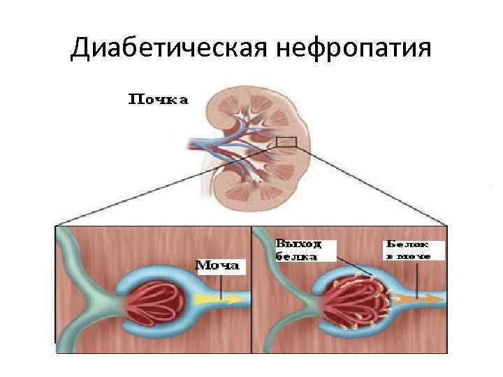 Диабетическая нефропатия 