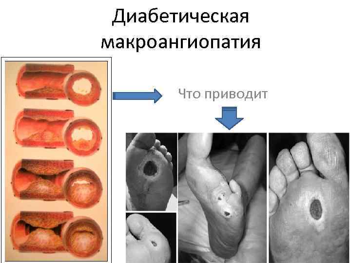 Диабетическая макроангиопатия Что приводит 