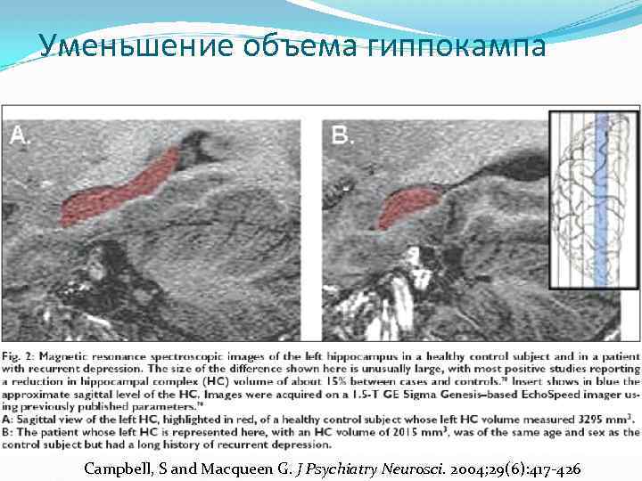 Уменьшение объема гиппокампа Campbell, S and Macqueen G. J Psychiatry Neurosci. 2004; 29(6): 417