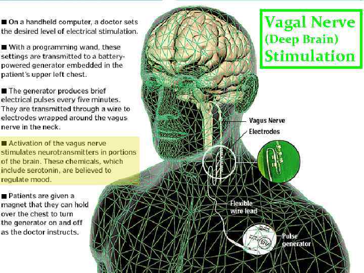 Vagal Nerve (Deep Brain) Stimulation 