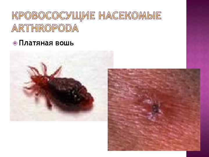  Платяная вошь 