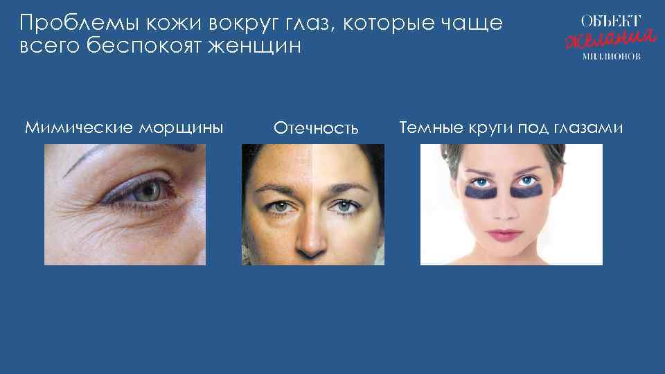 Проблемы кожи вокруг глаз, которые чаще всего беспокоят женщин Мимические морщины Отечность Темные круги