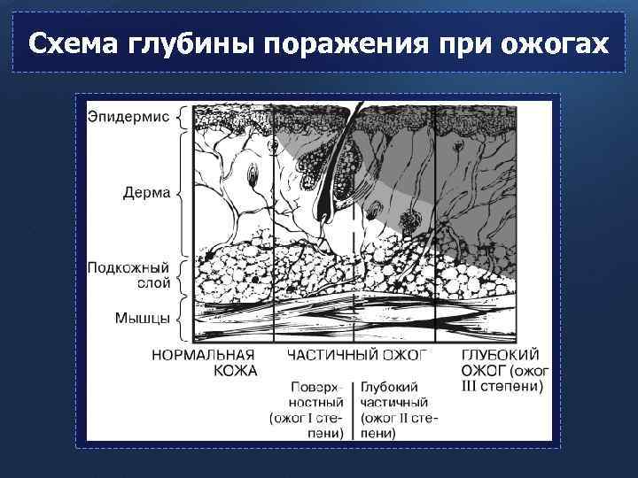 Схема глубины поражения при ожогах 