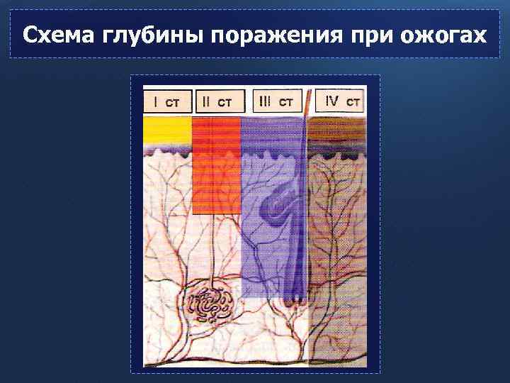 Схема глубины поражения при ожогах 