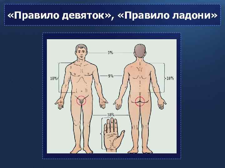  «Правило девяток» , «Правило ладони» 