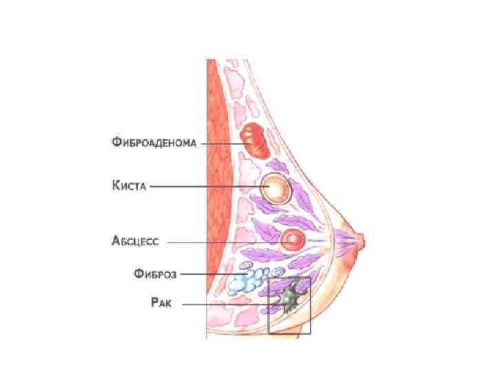 Заболевание женских молочных желез. Заболевания молочных желез. Нарушение молочных желез. Болезни молочных желез у женщин. Молочная железа у женщин строение мастопатия.