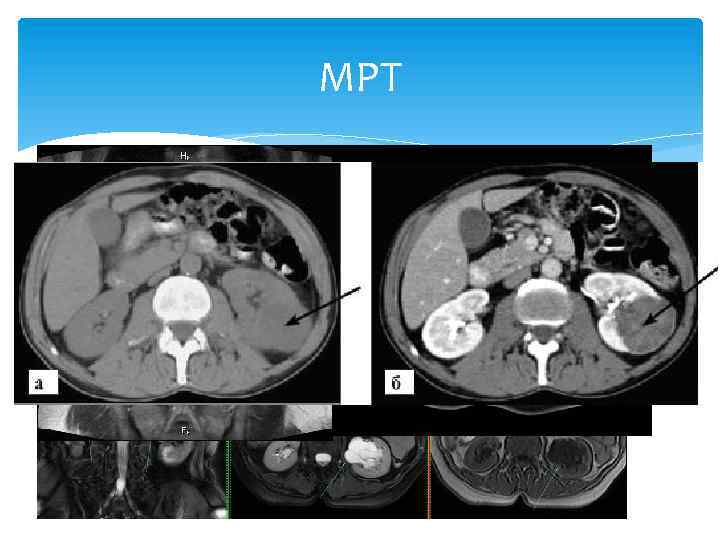 МРТ Более точное исследование Лучшая визуализация мягких тканей Различные патологии почек Оценка опухолевой прогрессии
