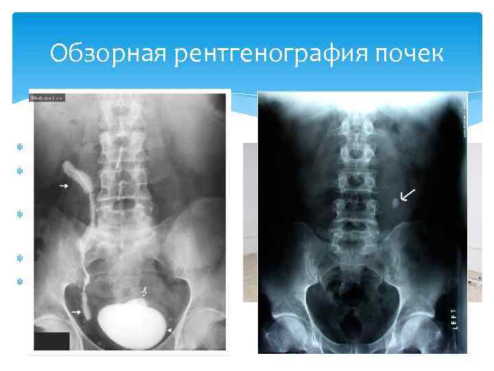 Обзорная рентгенография почек Беcконтрастная Rg Зармеры и расположение, камни Патологии органов брюшной полости Специальная