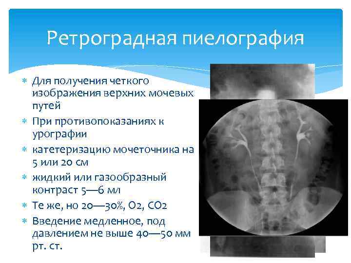 Ретроградная пиелография Для получения четкого изображения верхних мочевых путей При противопоказаниях к урографии катетеризацию