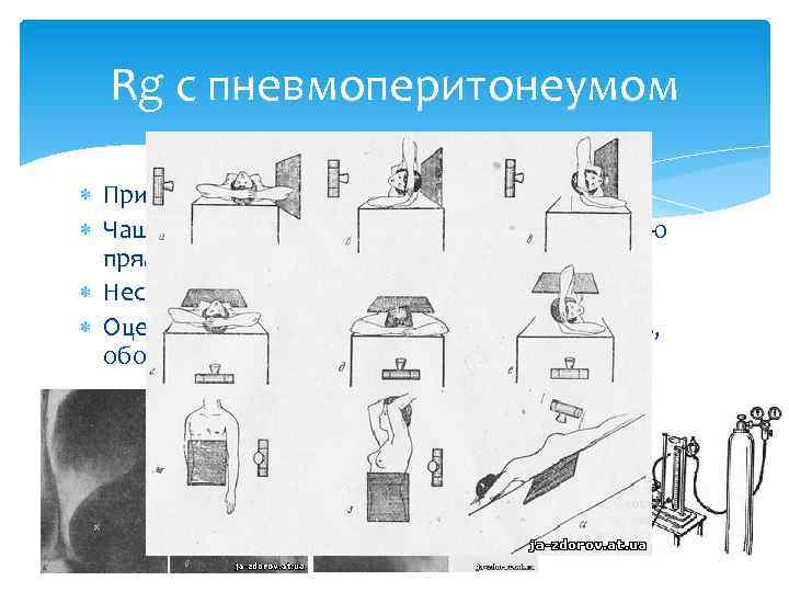 Rg с пневмоперитонеумом При онкологии Чаще слева в нижнем квадранте живота по краю прямой