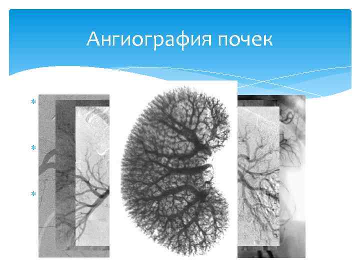 Ангиография почек транслюмбальная и трансфеморальная аортография Два снимка в начале ввода, один — в