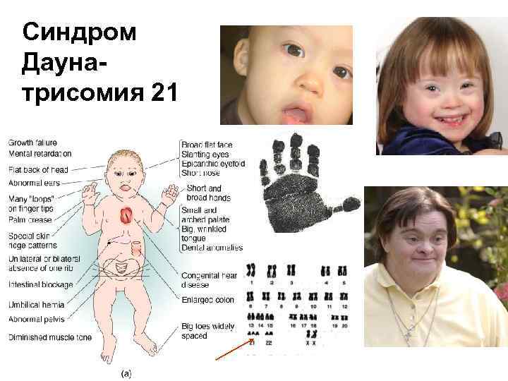 Синдром Даунатрисомия 21 