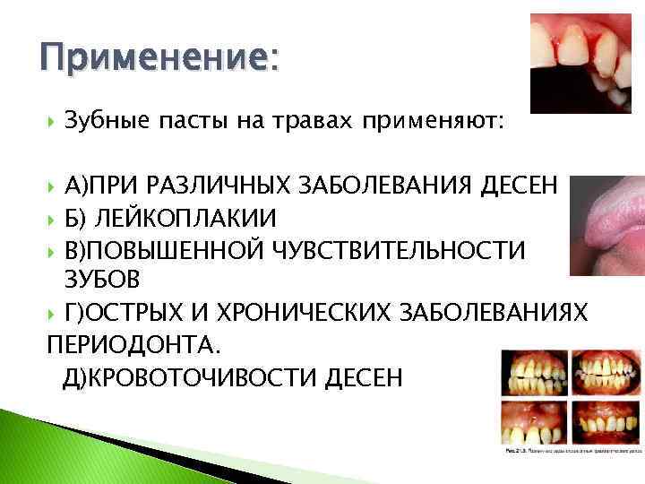 Применение: Зубные пасты на травах применяют: А)ПРИ РАЗЛИЧНЫХ ЗАБОЛЕВАНИЯ ДЕСЕН Б) ЛЕЙКОПЛАКИИ В)ПОВЫШЕННОЙ ЧУВСТВИТЕЛЬНОСТИ