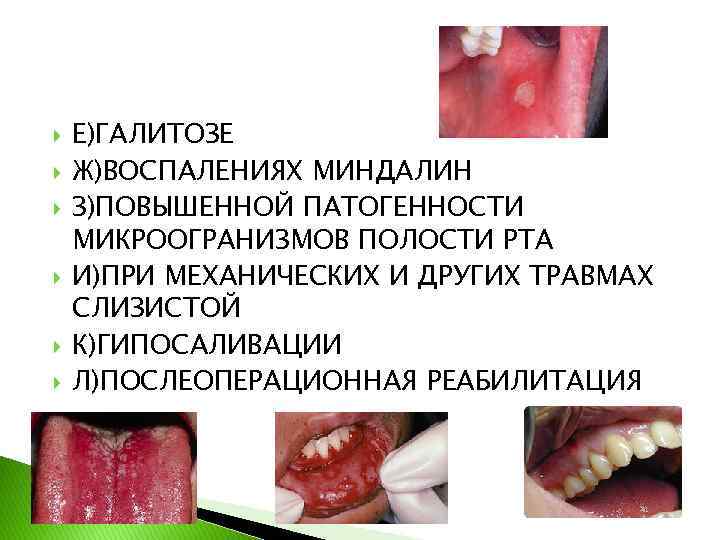  Е)ГАЛИТОЗЕ Ж)ВОСПАЛЕНИЯХ МИНДАЛИН З)ПОВЫШЕННОЙ ПАТОГЕННОСТИ МИКРООГРАНИЗМОВ ПОЛОСТИ РТА И)ПРИ МЕХАНИЧЕСКИХ И ДРУГИХ ТРАВМАХ