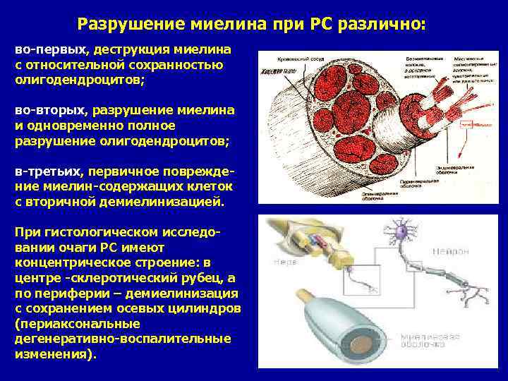 Разрушение миелина при PC различно: во-первых, деструкция миелина с относительной сохранностью олигодендроцитов; во-вторых, разрушение