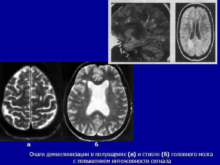 а б Очаги демиелинизации в полушариях (а) и стволе (б) головного мозга с повышением