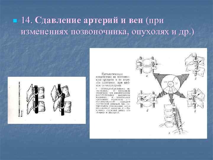 n 14. Сдавление артерий и вен (при изменениях позвоночника, опухолях и др. ) 