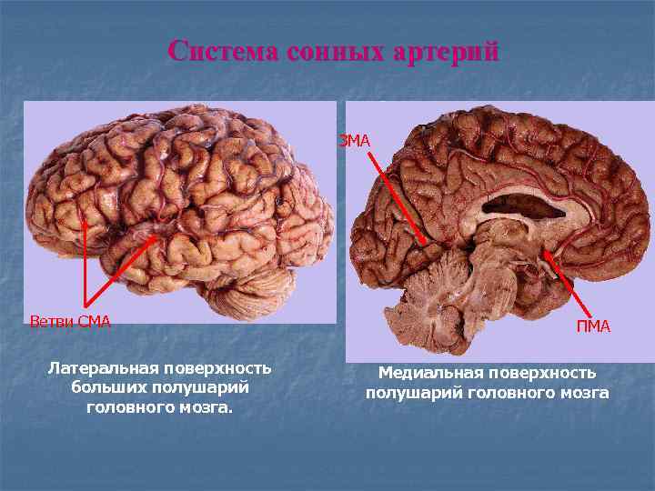 Система сонных артерий ЗМА Ветви СМА Латеральная поверхность больших полушарий головного мозга. ПМА Медиальная