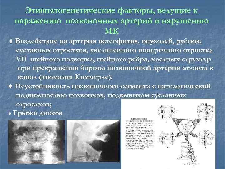 Этиопатогенетические факторы, ведущие к поражению позвоночных артерий и нарушению МК ♦ Воздействие на артерии