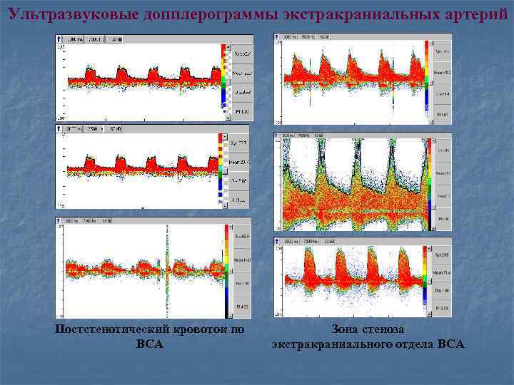 Ультразвуковые допплерограммы экстракраниальных артерий Постстенотический кровоток по ВСА Зона стеноза экстракраниального отдела ВСА 