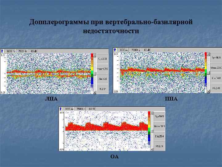 Допплерограммы при вертебрально-базилярной недостаточности ЛПА ППА ОА 