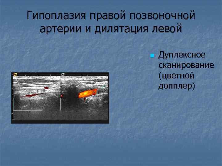 Гипоплазия правой позвоночной артерии и дилятация левой n Дуплексное сканирование (цветной допплер) 