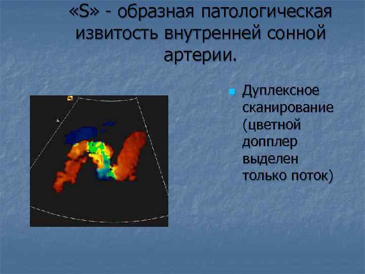  «S» - образная патологическая извитость внутренней сонной артерии. n Дуплексное сканирование (цветной допплер