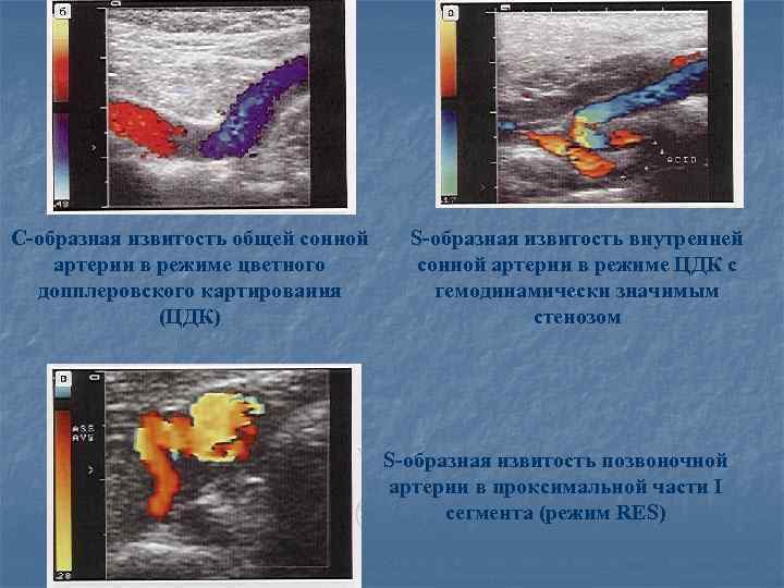 С-образная извитость общей сонной артерии в режиме цветного допплеровского картирования (ЦДК) S-образная извитость внутренней