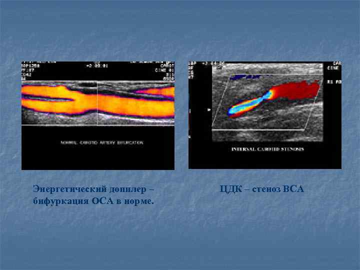 Энергетический допплер – бифуркация ОСА в норме. ЦДК – стеноз ВСА 