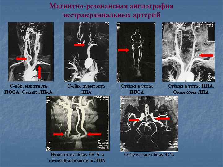 Магнитно-резонансная ангиография экстракраниальных артерий С-обр. извитость ПОСА. Стеноз ЛПк. А С-обр. извитость ЛПА Извитость