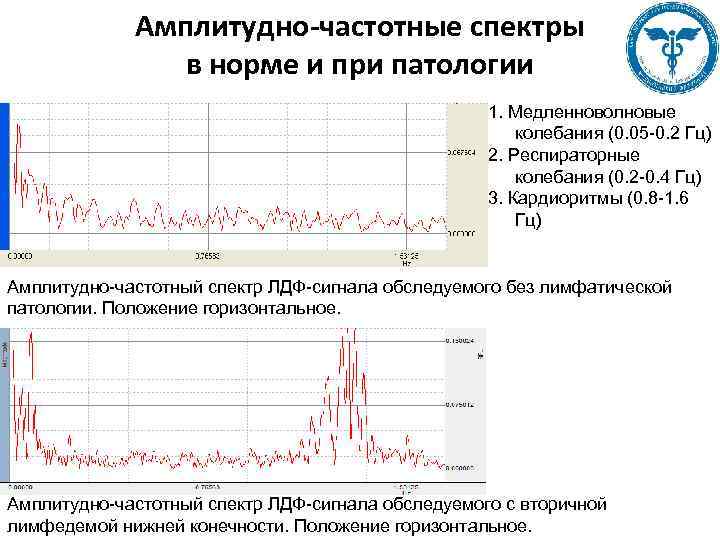 Амплитудно-частотные спектры в норме и при патологии 1. Медленноволновые колебания (0. 05 -0. 2