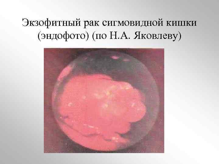 Рак толстой кишки картинки